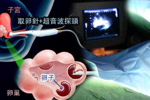 广州代孕包成功,不想接触广州地下供卵机构，广州合法供卵试管中心在哪里？